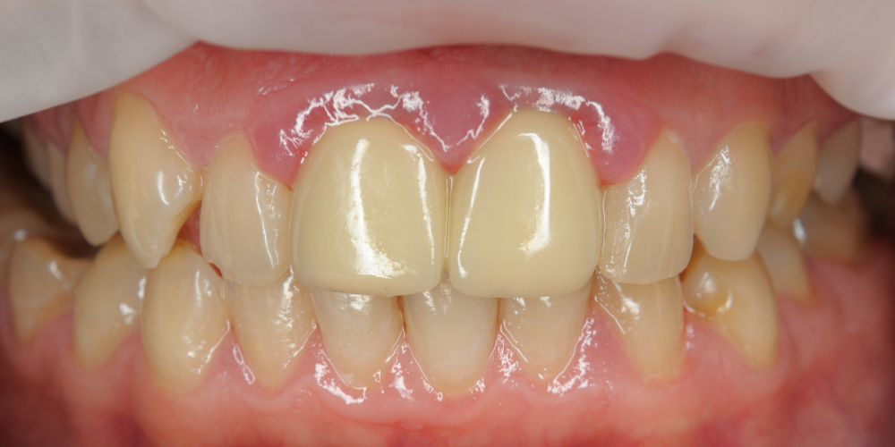  Протезирование двух центральных резцов цельнокерамическими коронками E.Max и отбеливание зубов