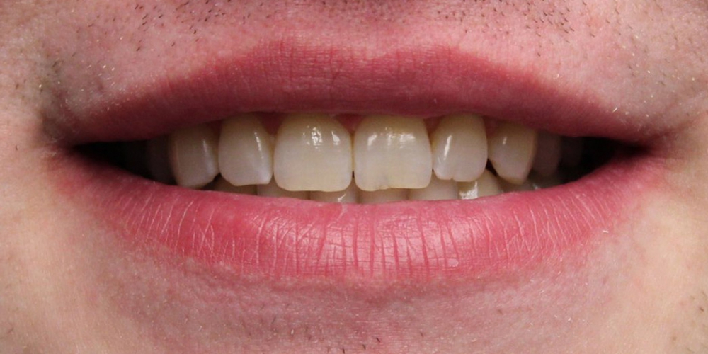  Отбеливание зубов в зоне широкой улыбки