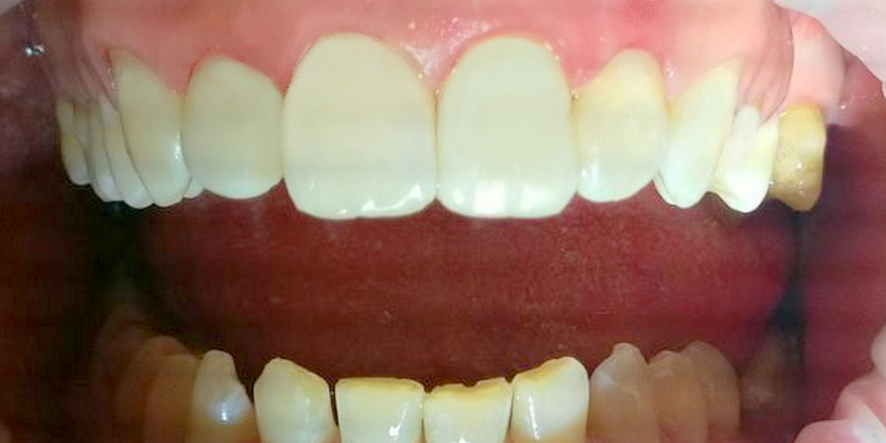  Лечения кариеса четырех передних зубов верхней челюсти современным композиционным материалом