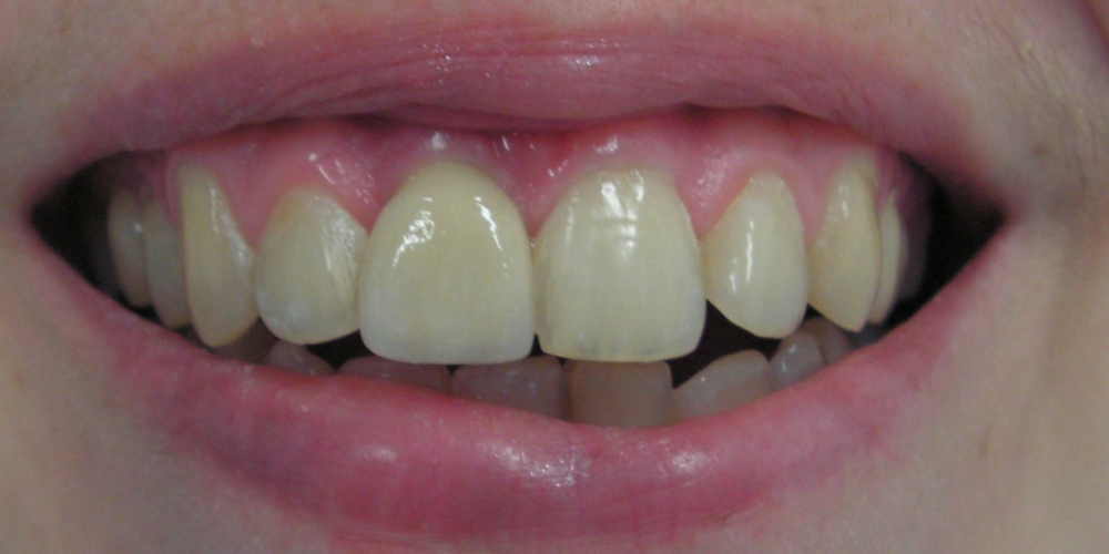 Имплантация и протезирование переднего зуба