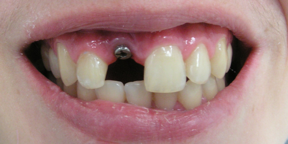  Имплантация и протезирование переднего зуба