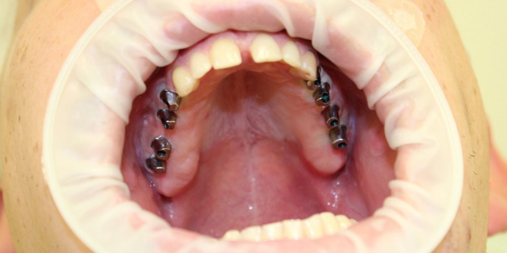 Произведена установка  8 имплантатов  в области отсутствующих жевательных зубов верхней челюсти. Имплантация и протезирование жевательных зубов верхней челюсти