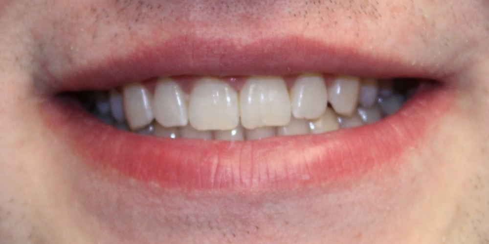  Отбеливание зубов в зоне широкой улыбки