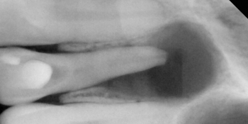 Жалобы на отек мягких тканей лица и боли при накусывании на зуб фото до лечения