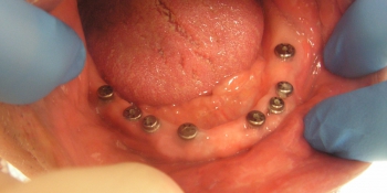 Имплантация и протезирование полной челюсти фото до лечения