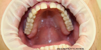 Имплантация и протезирование жевательных зубов верхней челюсти фото после лечения