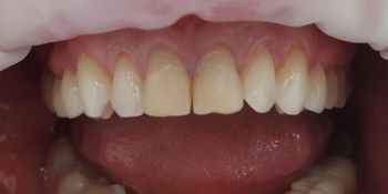 Реставрация двух передних зубов верхней челюсти современным композиционным материалом фото до лечения