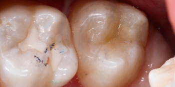 Лечение кариеса, реставрация зуба фото после лечения