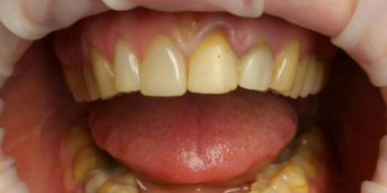 Реставрация зубов верхней челюсти фото до лечения