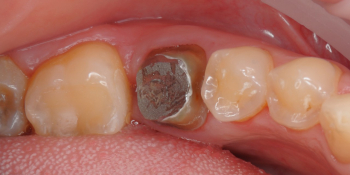 Произвели восстановление функции жевательного зуба разрушенного на 80% фото до лечения